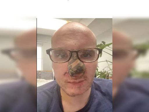 UK Man Reconstructs Nose Ripped Off By Dog Using Bone From His Ribs