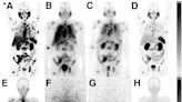 Lower dose prostate cancer treatments found to retain efficacy while improving tolerability