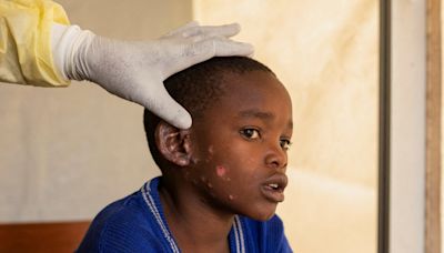 Africa’s worsening mpox outbreak can no longer be ignored – here’s what needs to be done