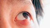 What Is a Stye?