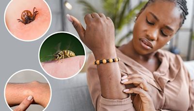 Warning over 4 common bug bites - and when to seek urgent medical help