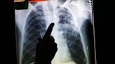 Levofloxacin could be a cheap solution to drug-resistant tuberculosis, studies say