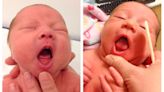 American Academy of Pediatrics warns against overdiagnosing tongue-tie in infants