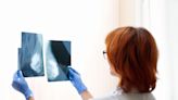 Low risk of overdiagnosis linked to breast cancer screening – study