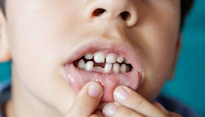 健康網》牙齒外傷、斷牙分8類 醫：未及時治療恐影響咀嚼 - 自由健康網