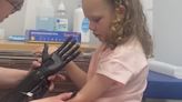 Loves Park girl to receive bionic prosthetic arm inspired by movie superheroes