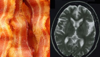 Eating more processed red meat is linked to an increased risk of dementia, study suggests