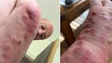 Dad left with red itchy bites after buying 'second hand' sofa from ScS