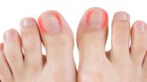 10 Effective Remedies for Toenail Fungus That Could Save Your Nail - WV MetroNews