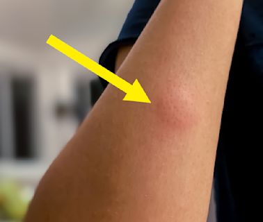 Experts Are Sharing The One Crucial Mistake You Should Absolutely Avoid With Mosquito Bites