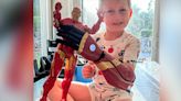 5-year-old boy becomes youngest to ever receive bionic arm