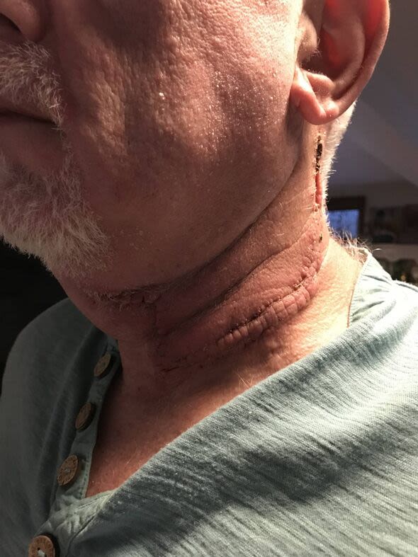 Man who spotted early cancer sign in his mouth says 'seek help'