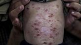 Lice, scabies, rashes plague Palestinian children as skin disease runs rampant in Gaza’s tent camps