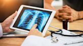 Fewer than 1 in 5 eligible Americans up to date with lung cancer screenings