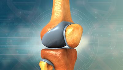 Innovations in knee replacement: the way for market growth