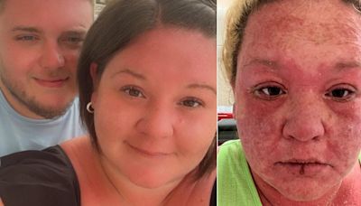 I was on my dream holiday – then my skin started falling off