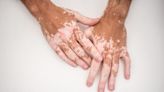 How skin conditions like vitiligo affect mental health