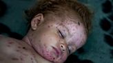 Lice, scabies, rashes plague Palestinian children as skin disease runs rampant in Gaza’s tent camps