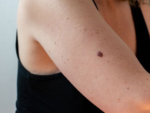 3 Types of Skin Cancer That Should Be on Everyone's Radar