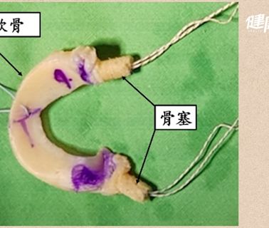 膝蓋痛怎麼辦？膝蓋卡卡能治療嗎？半月板受損用異體移植 避免提早換關節