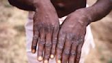 Monkeypox cases are on the rise: What you need to know about the painful disease