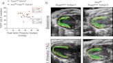 Study elucidates mechanism behind cardiac fibrosis, opening way for new heart failure treatments