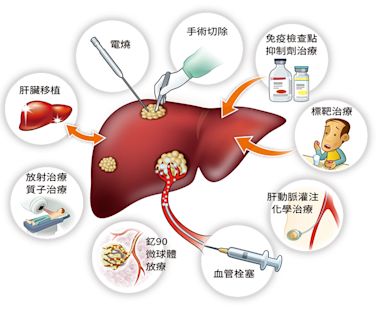 術後第一年復發率約 20 % ！ 肝癌治療後， 減少復發率可以怎麼做？