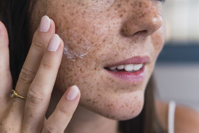 What Are Freckles and Why Do They Appear?