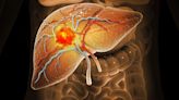 Liver Resection Improves Survival in Early Multinodular HCC