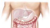 Anti-inflammatory drug celecoxib could reduce risk of colon cancer recurrence for a subset of patients