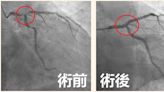 每天3包菸！他胸悶裝心臟支架「撐半年又全塞」 2度復活嘆：不敢抽了