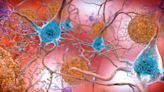 Time is of the essence when it comes to accessing Alzheimer’s treatments | Opinion