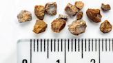 Office Procedure Found to Get Stone Fragments Rolling