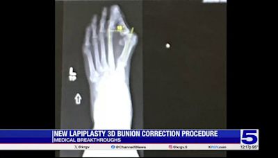 Medical Breakthroughs: New procedure treats the root cause of bunions