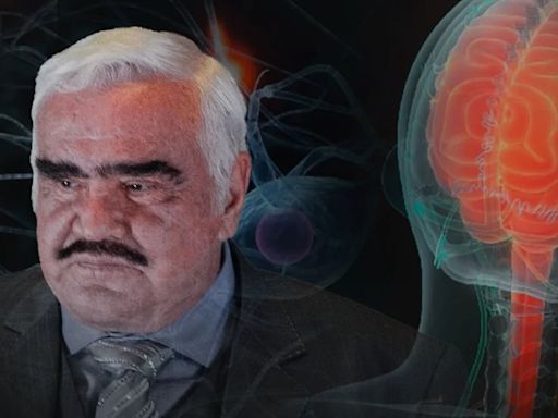 ¿Muerte de Vicente Fernández advirtió sobre casos del síndrome Guillain-Barré que hoy registra Tlaxcala?