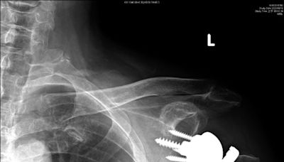 阿北肱骨粉碎性骨折 反置式關節加快癒合 - 自由健康網