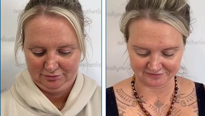 Needle-free treatment to get rid of neck fat becomes available in UK