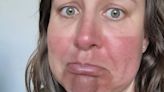 Sunburnt mum left 'looking like drumstick lolly' after too long reading in garden