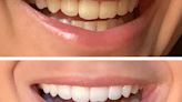 Shoppers can't get over 'game-changing' teeth whitening powder you can get for less in money saving deal