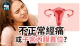 婦科疾病｜不正常經痛 或子宮內膜異位？