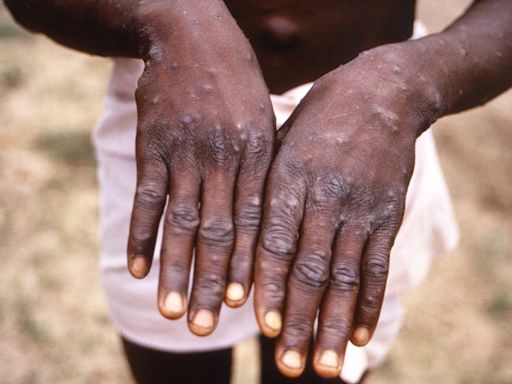 Fears new 'most dangerous' mpox strain could cross borders