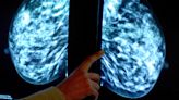 Immune cell discovery ‘could lead to personalised treatment for breast cancer’