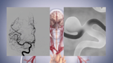 Your Health: A new tool to help combat brain aneurysms