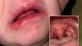 Fifteen children have died from Strep A in the UK in recent weeks. Could an outbreak in the US follow?