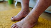 Diabetic Foot: Charting the Course of the Effect on Feet