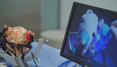 港大團隊改良技術 提升立體定位神經外科手術精確度 - RTHK