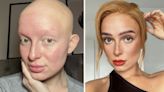'My alopecia meant I didn't leave the house for two years'