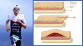 What Are Morel-Lavallée Lesions? Understanding Jan Frodeno’s Injury