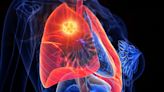 Is Osimertinib Better Alone or With Chemotherapy in NSCLC?