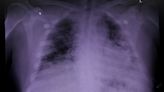 US race-neutral lung assessments to have profound effects, study finds